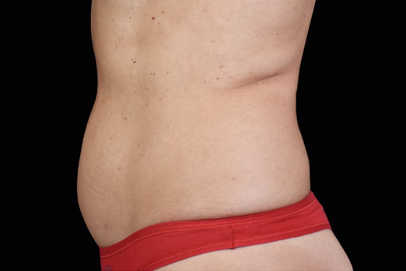 Emsculpt NEO Before & After Gallery - Patient 162826 - Image 2