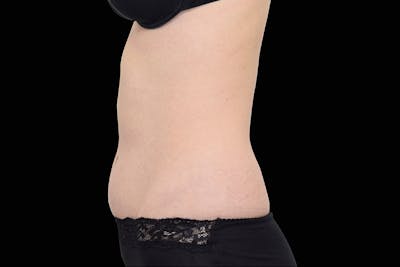 Emsculpt NEO Before & After Gallery - Patient 398926 - Image 2