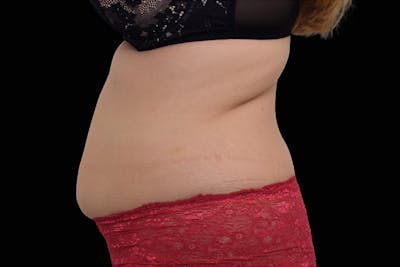 Emsculpt NEO Before & After Gallery - Patient 216925 - Image 1