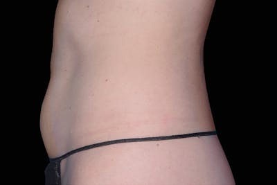 Emsculpt NEO Before & After Gallery - Patient 268019 - Image 1