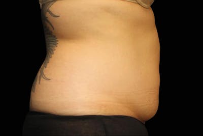 Emsculpt NEO Before & After Gallery - Patient 288752 - Image 2
