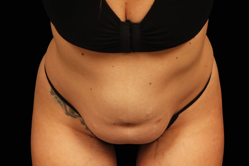 Emsculpt NEO Before & After Gallery - Patient 111069 - Image 1