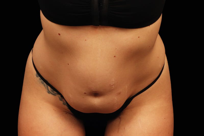 Emsculpt NEO Before & After Gallery - Patient 111069 - Image 2