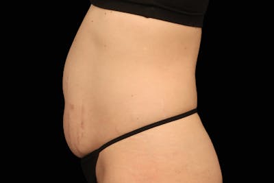Emsculpt NEO Before & After Gallery - Patient 669254 - Image 1