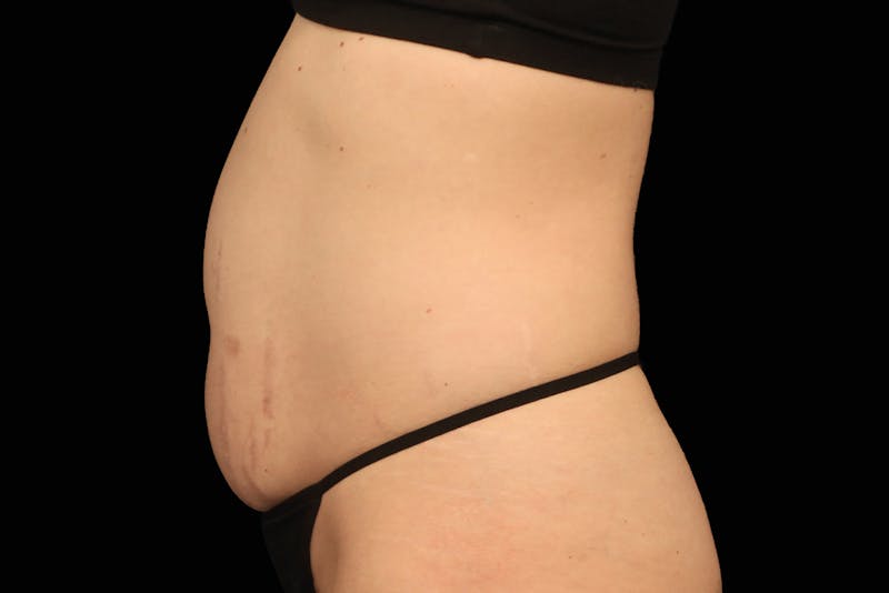 Emsculpt NEO Before & After Gallery - Patient 669254 - Image 1
