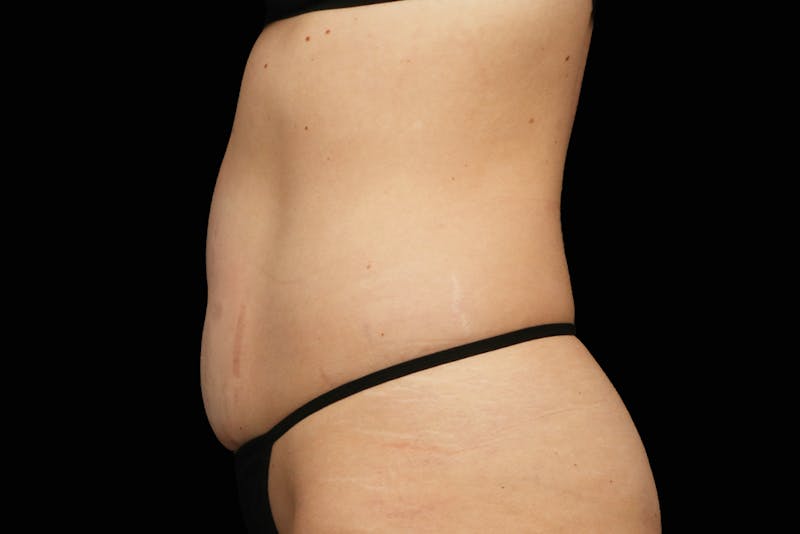 Emsculpt NEO Before & After Gallery - Patient 669254 - Image 2