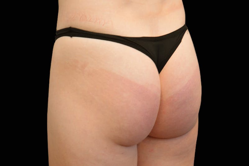 Emsculpt NEO Before & After Gallery - Patient 222340 - Image 1