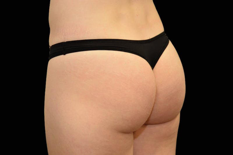 Emsculpt NEO Before & After Gallery - Patient 222340 - Image 2