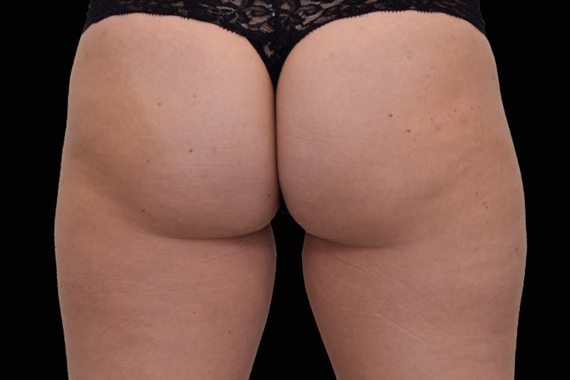 Emsculpt NEO Before & After Gallery - Patient 754082 - Image 2