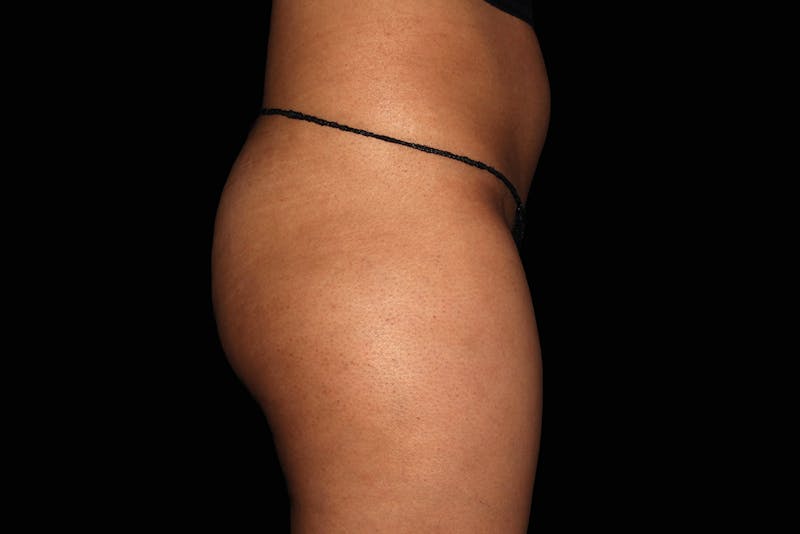 Emsculpt NEO Before & After Gallery - Patient 164273 - Image 1