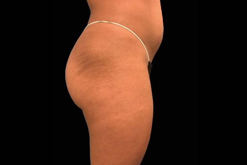 Emsculpt NEO Before & After Gallery - Patient 330440 - Image 2