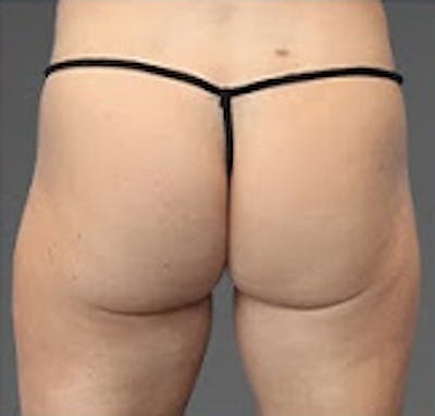Cooltone Before & After Gallery - Patient 215336 - Image 1