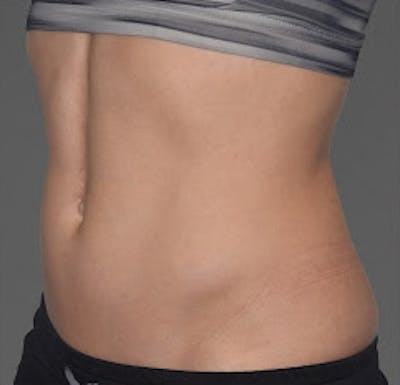 Cooltone Before & After Gallery - Patient 867069 - Image 1