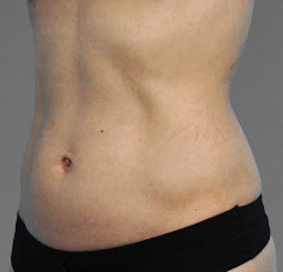 Cooltone Before & After Gallery - Patient 363250 - Image 1