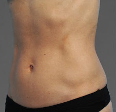 Cooltone Before & After Gallery - Patient 363250 - Image 2