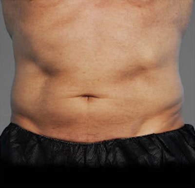 Cooltone Before & After Gallery - Patient 368684 - Image 1