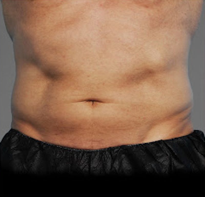 Cooltone Before & After Gallery - Patient 368684 - Image 1