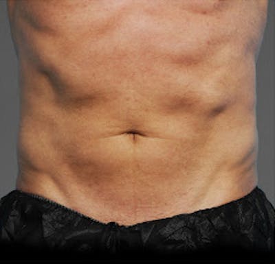 Cooltone Before & After Gallery - Patient 368684 - Image 2