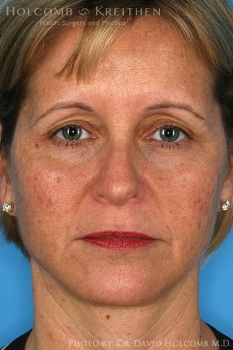 AccuLift Before & After Gallery - Patient 180413 - Image 2