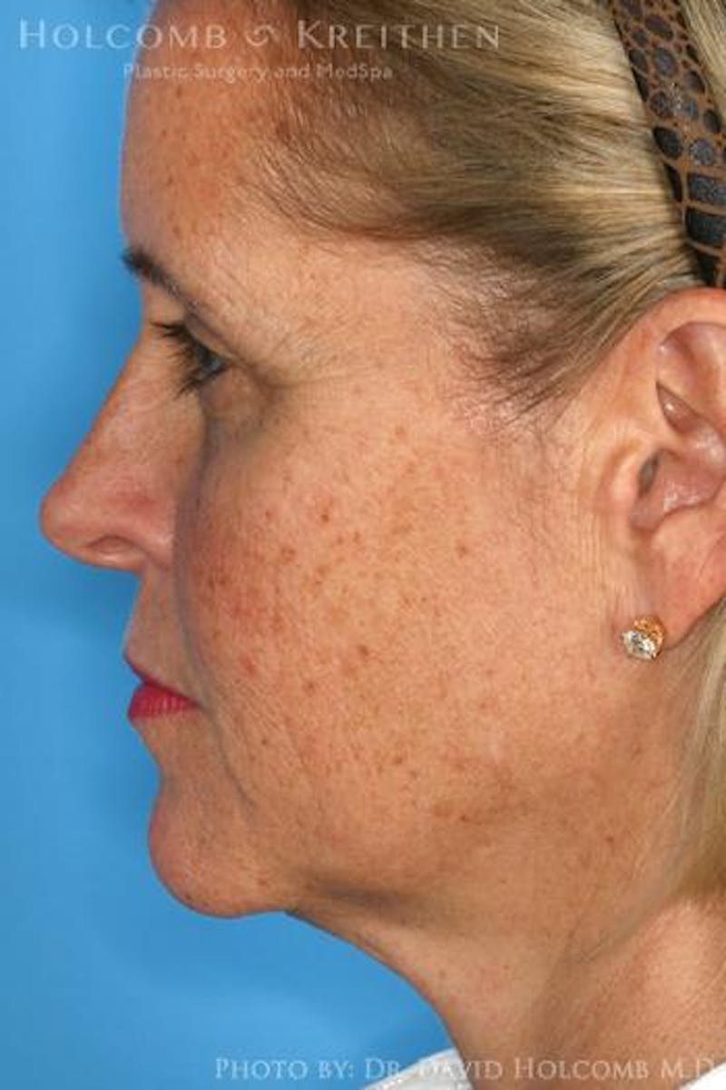 AccuLift Before & After Gallery - Patient 180413 - Image 5
