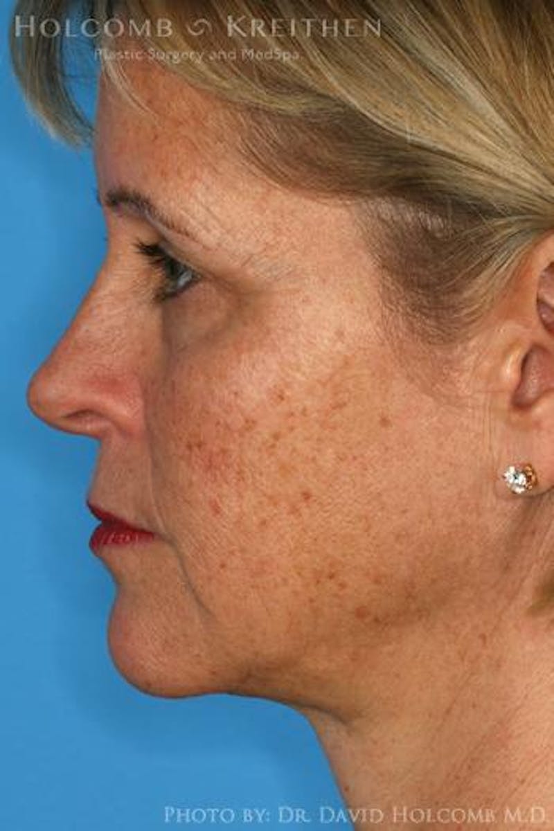 AccuLift Before & After Gallery - Patient 180413 - Image 6