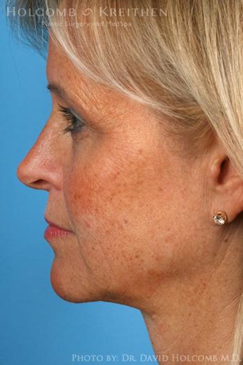 AccuLift Before & After Gallery - Patient 180413 - Image 8