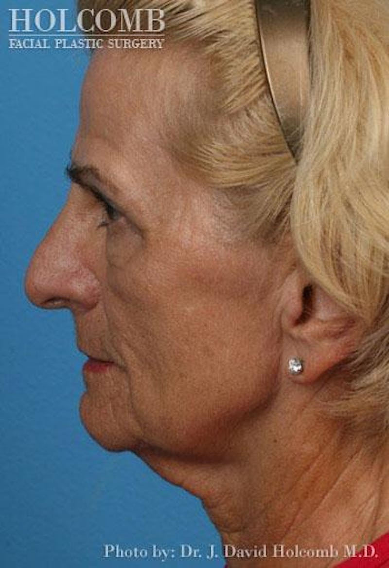 AccuLift Before & After Gallery - Patient 143222 - Image 3