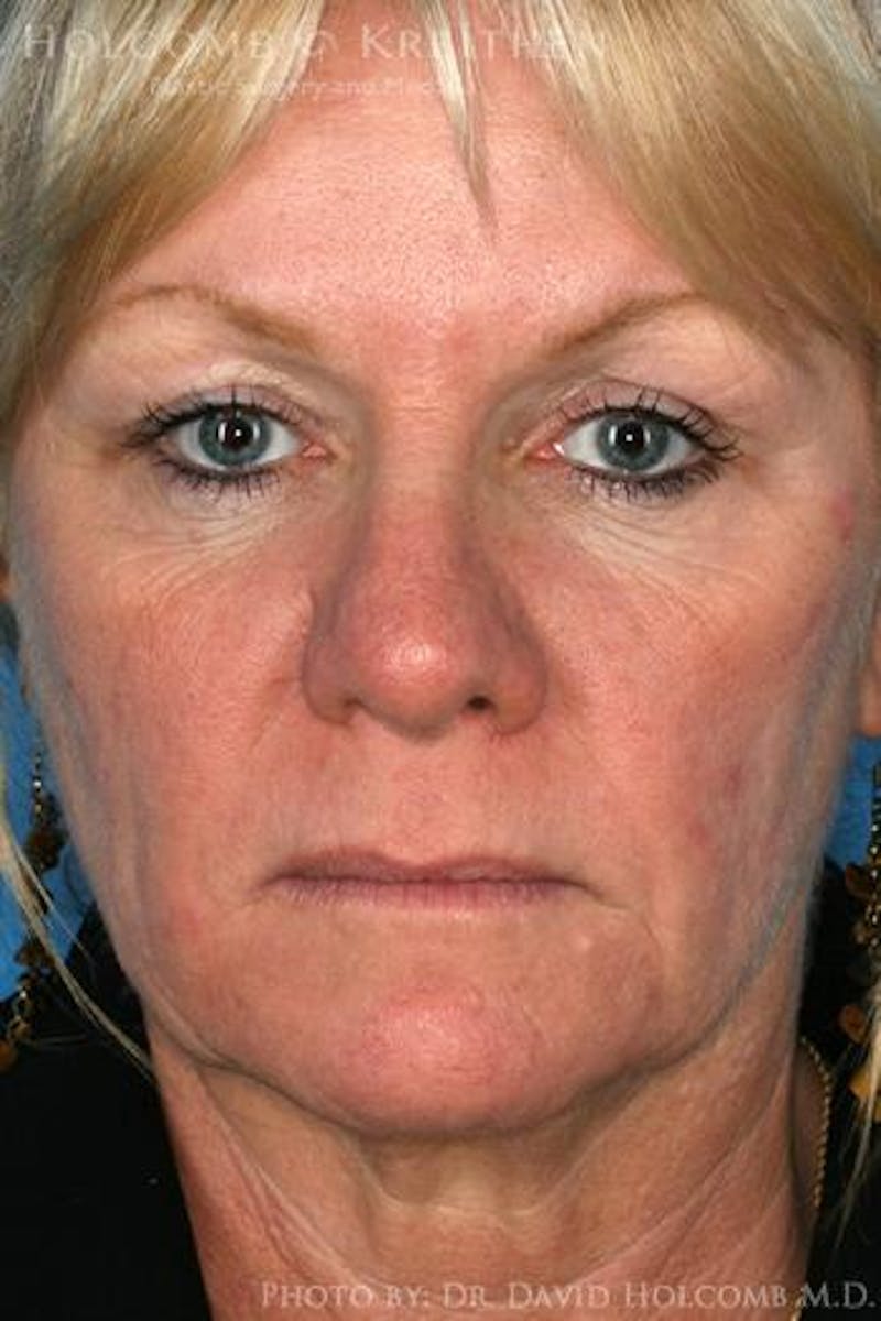 AccuLift Before & After Gallery - Patient 746018 - Image 1