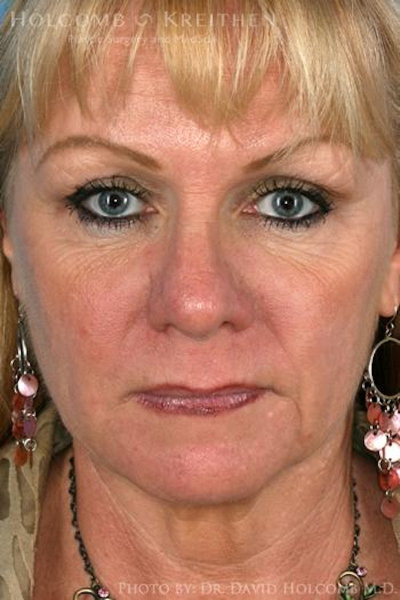 AccuLift Before & After Gallery - Patient 746018 - Image 2