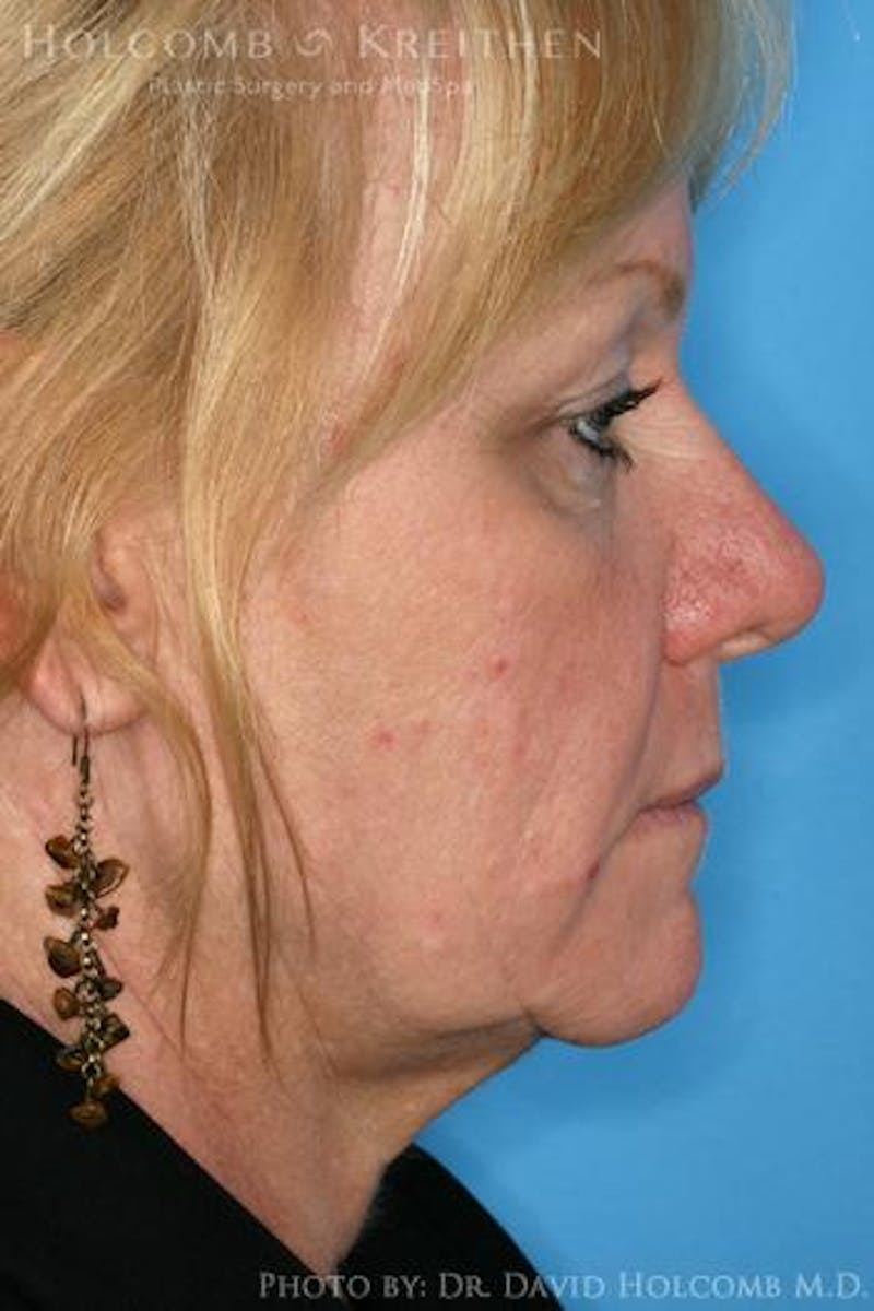 AccuLift Before & After Gallery - Patient 746018 - Image 3