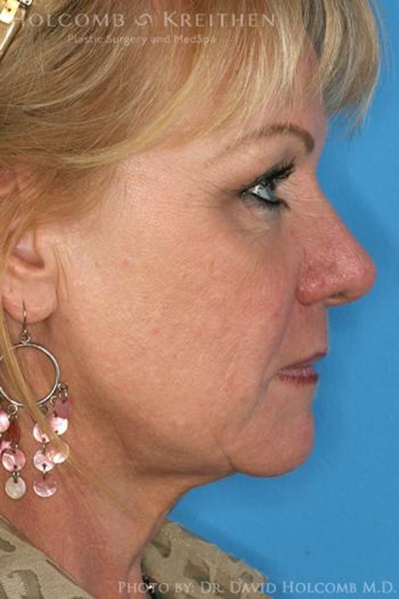 AccuLift Before & After Gallery - Patient 746018 - Image 4