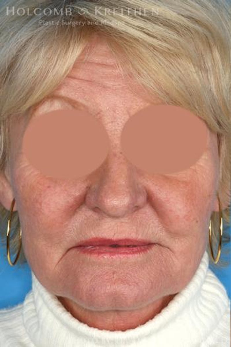 AccuLift Before & After Gallery - Patient 250479 - Image 1