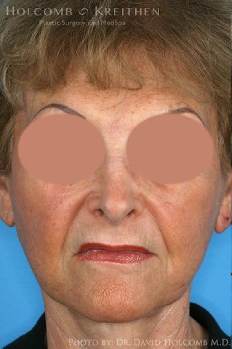 AccuLift Before & After Gallery - Patient 408129 - Image 1