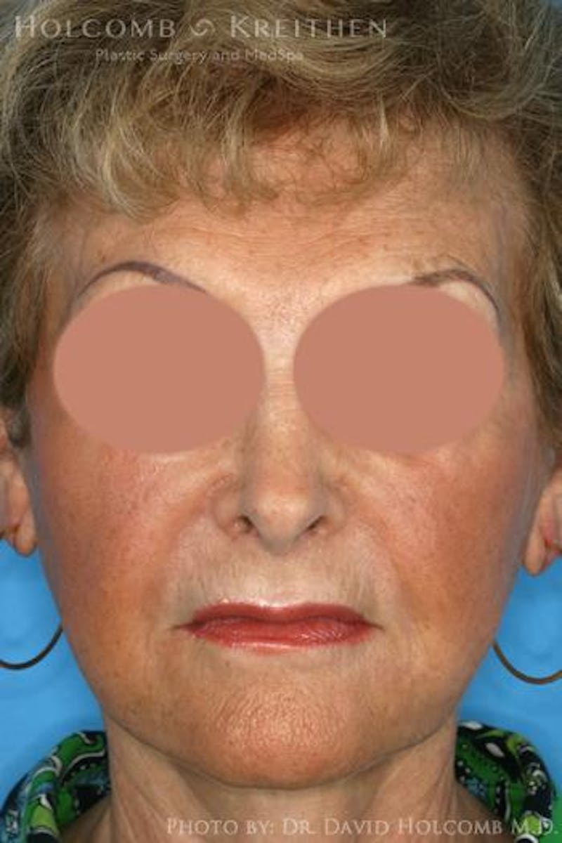 AccuLift Before & After Gallery - Patient 408129 - Image 2