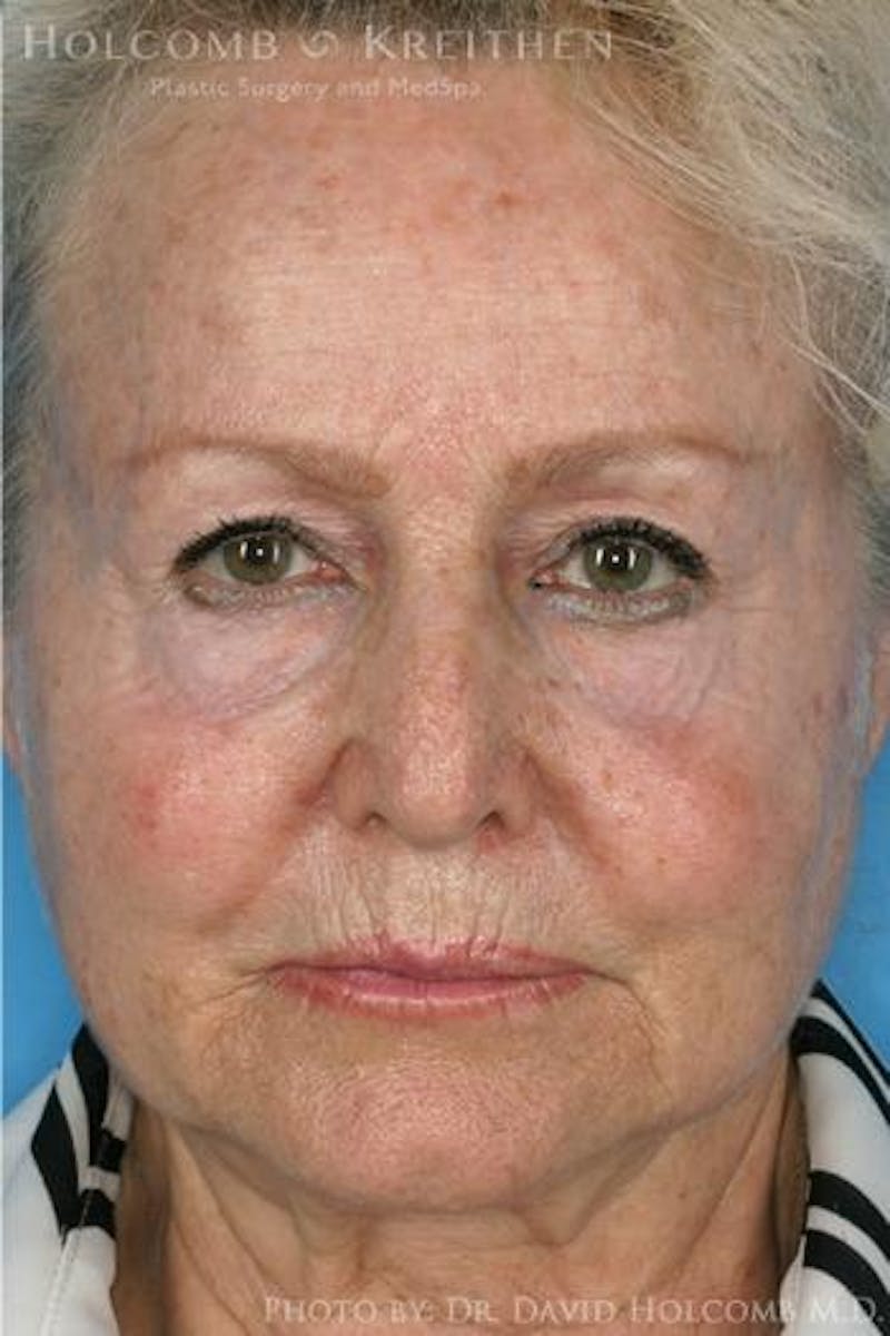 AccuLift Before & After Gallery - Patient 134217 - Image 1
