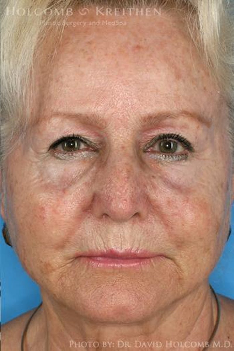 AccuLift Before & After Gallery - Patient 134217 - Image 2