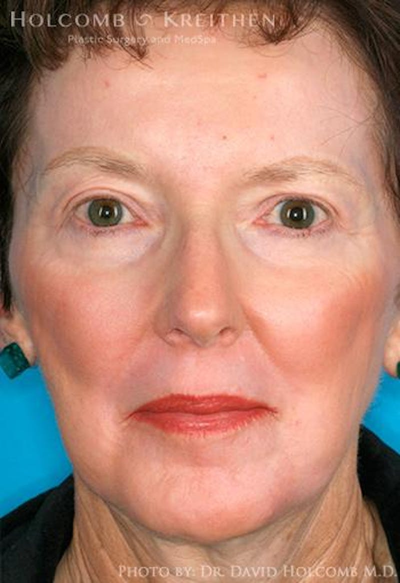 TRL Laser Skin Resurfacing Before & After Gallery - Patient 120256 - Image 2