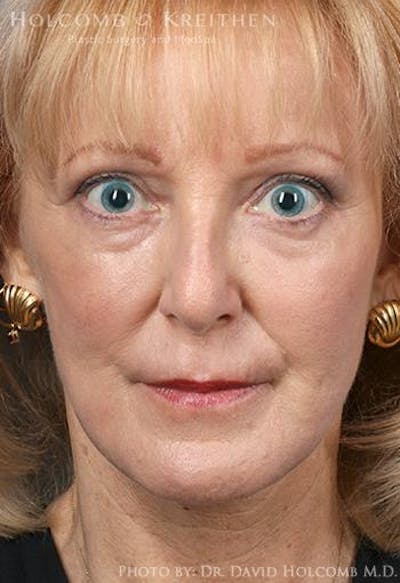 TRL Laser Skin Resurfacing Before & After Gallery - Patient 236071 - Image 2