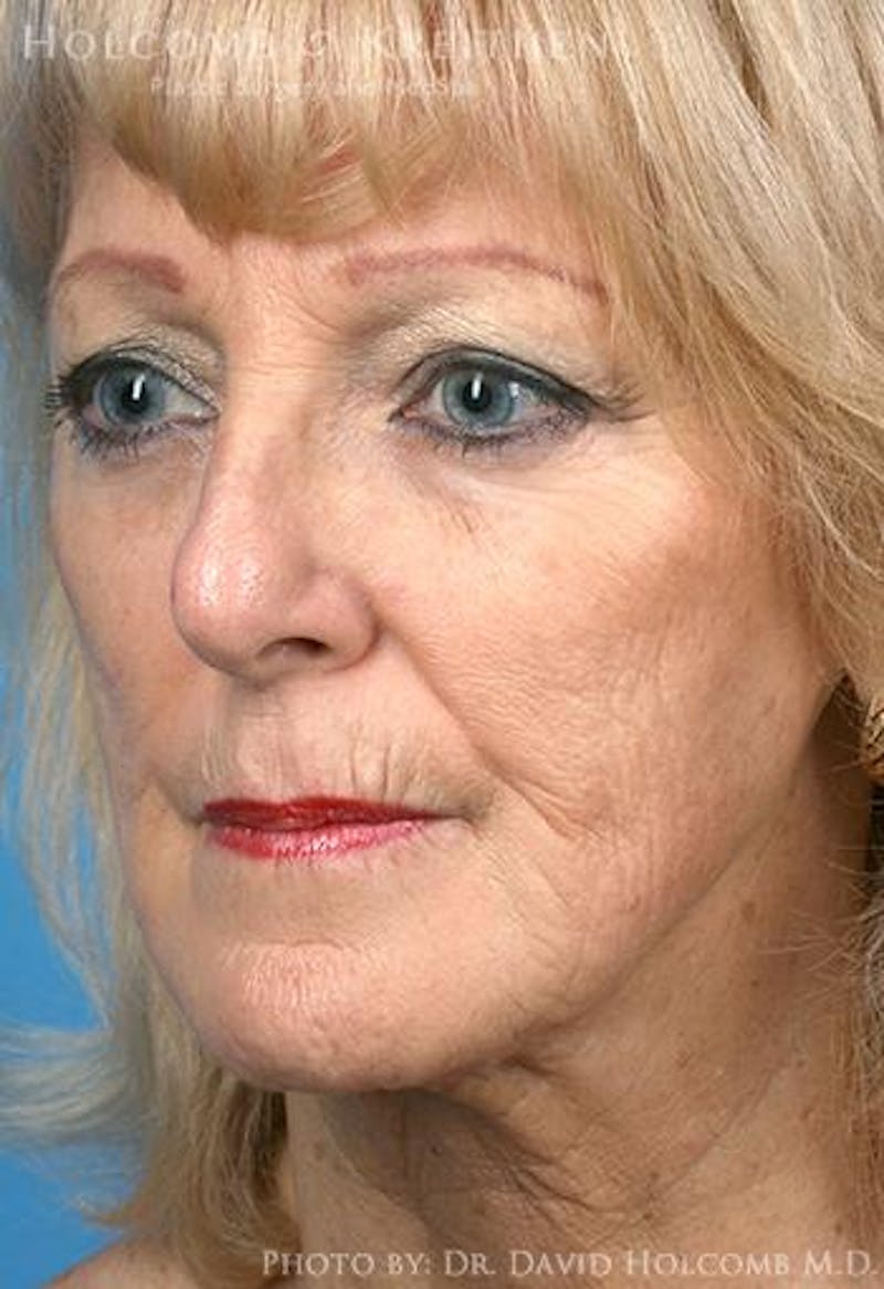 TRL Laser Skin Resurfacing Before & After Gallery - Patient 236071 - Image 3