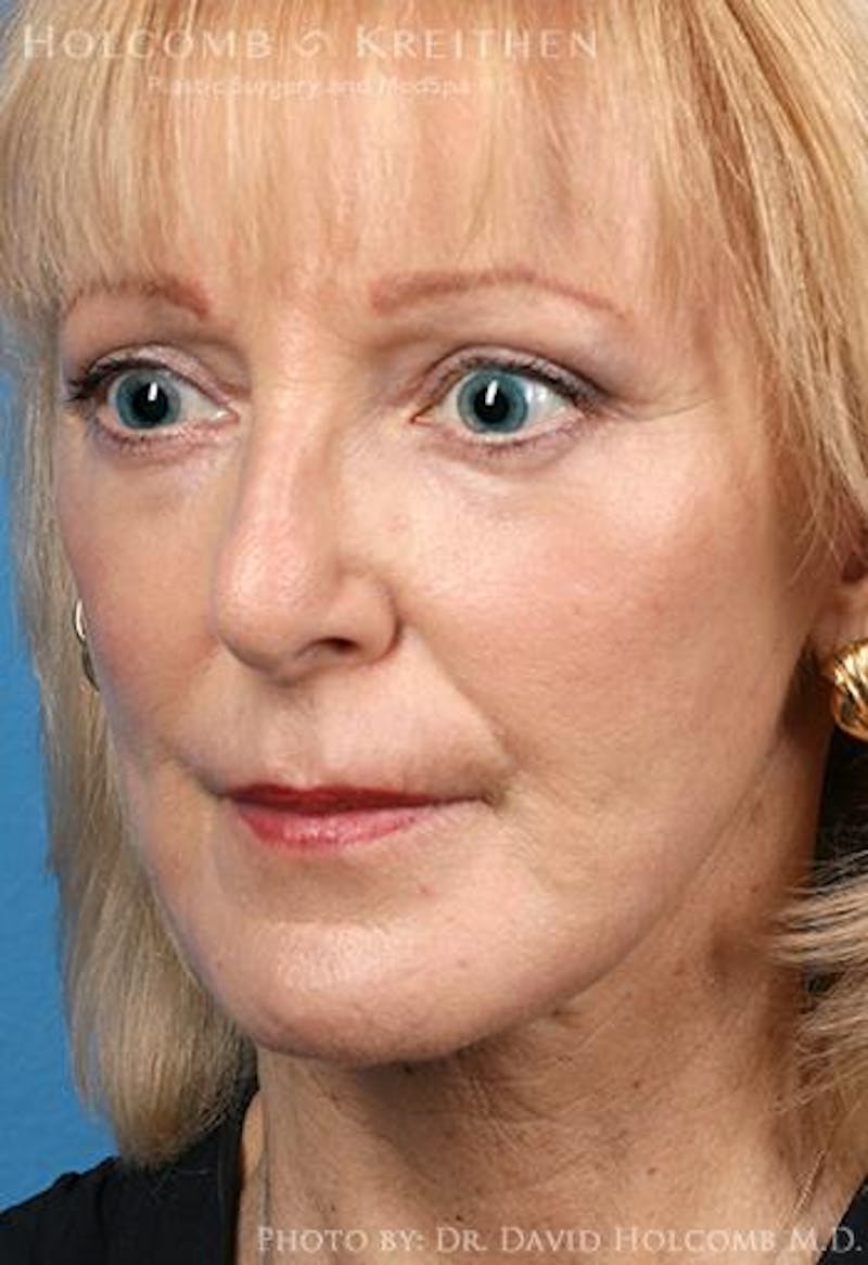 TRL Laser Skin Resurfacing Before & After Gallery - Patient 236071 - Image 4