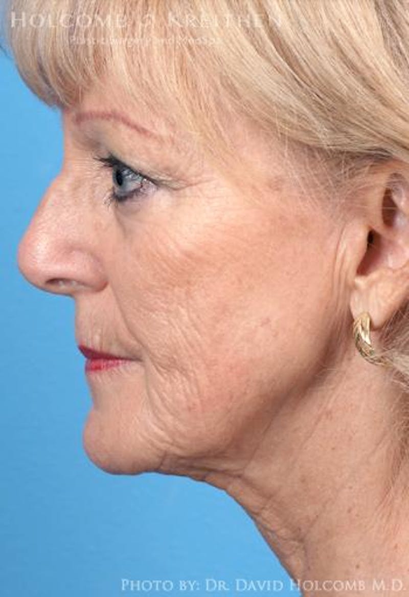 TRL Laser Skin Resurfacing Before & After Gallery - Patient 236071 - Image 5