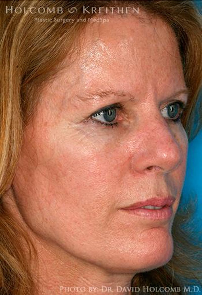 TRL Laser Skin Resurfacing Before & After Gallery - Patient 222129 - Image 1