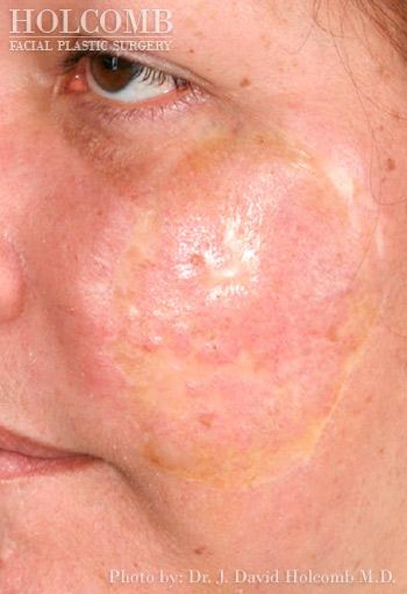 TRL Laser Skin Resurfacing Before & After Gallery - Patient 248830 - Image 1
