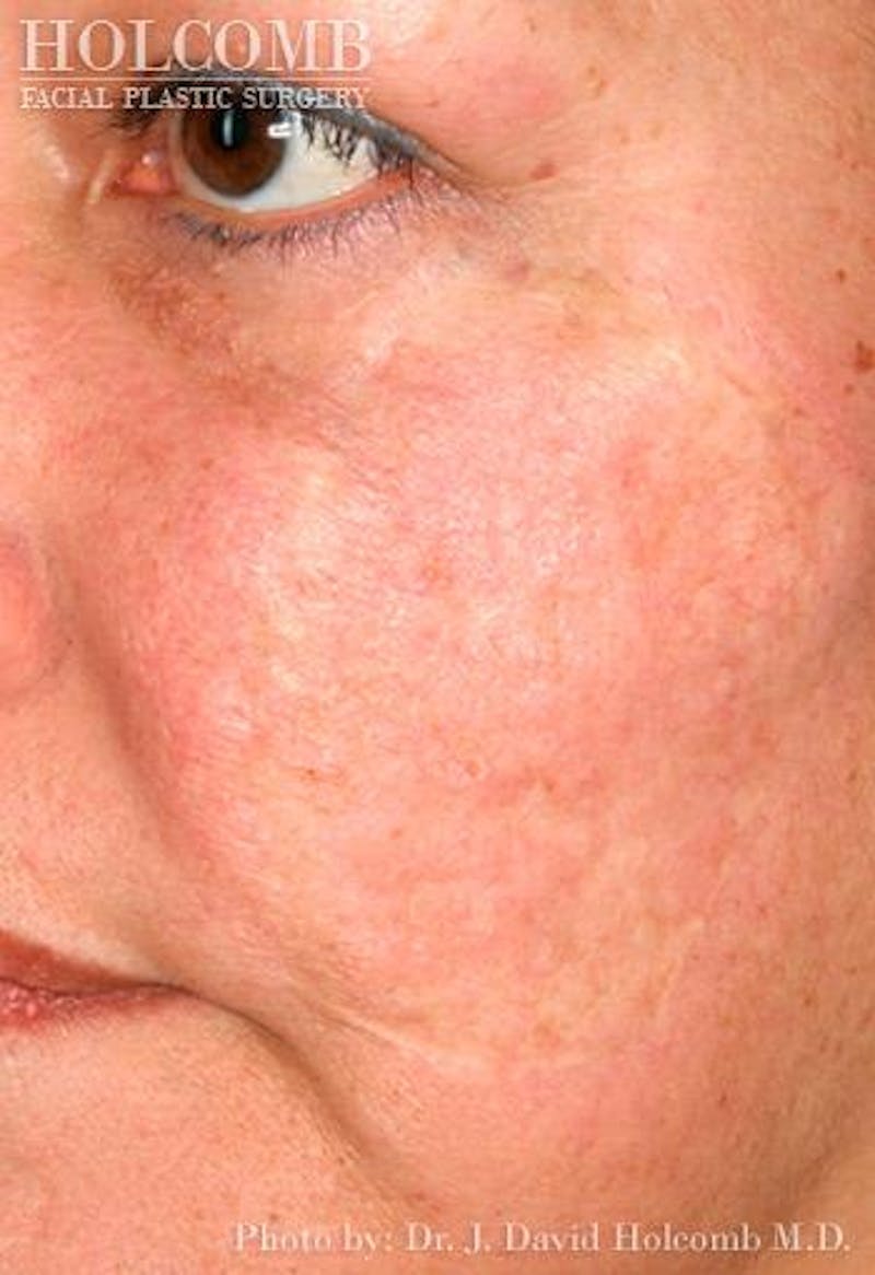 TRL Laser Skin Resurfacing Before & After Gallery - Patient 248830 - Image 2