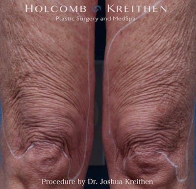 Morpheus  Before & After Gallery - Patient 126471 - Image 1