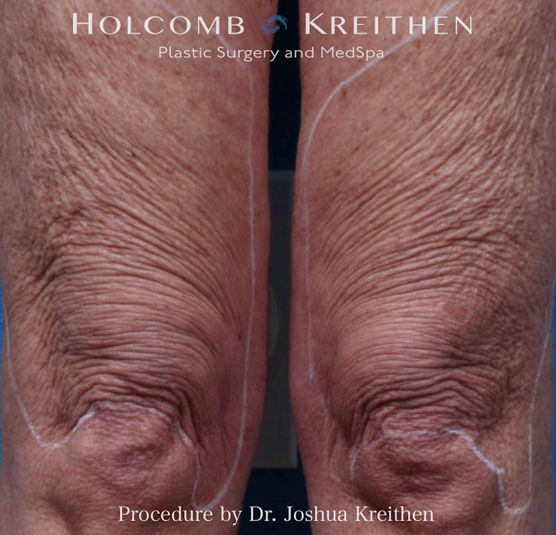 Morpheus  Before & After Gallery - Patient 126471 - Image 1