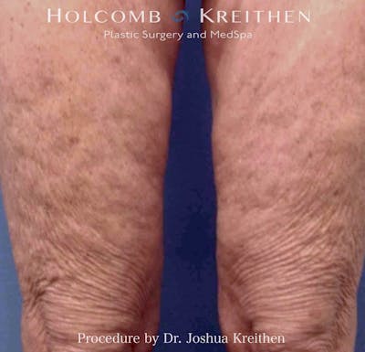 Morpheus  Before & After Gallery - Patient 126471 - Image 2