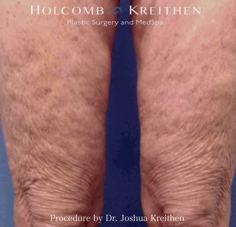 Morpheus  Before & After Gallery - Patient 126471 - Image 2