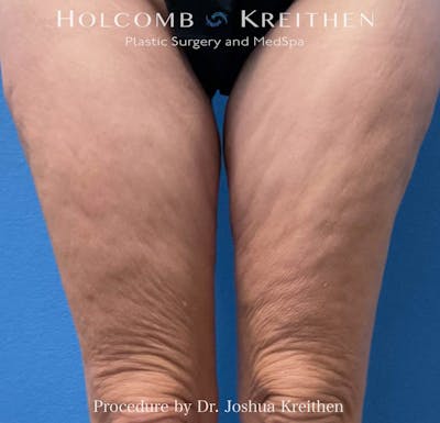 Morpheus  Before & After Gallery - Patient 970478 - Image 1