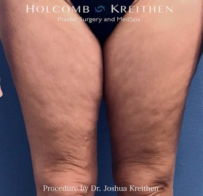 Morpheus  Before & After Gallery - Patient 970478 - Image 2